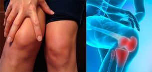 Discomfort and swelling in the knee area are the first symptoms of osteoarthritis