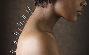 acupuncture