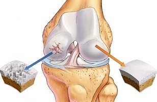 causes of osteoarthritis of the knee