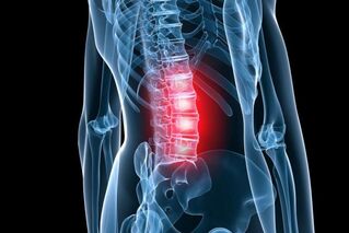 osteochondrosis of the lumbar spine